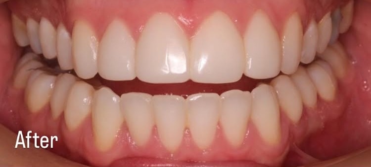 Clear aligners - after
