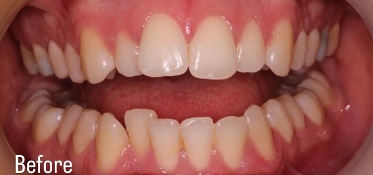 Clear aligners - before
