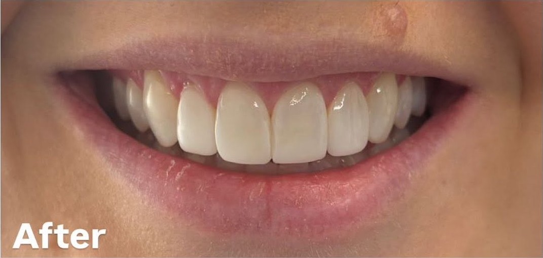 Composite bonding - after