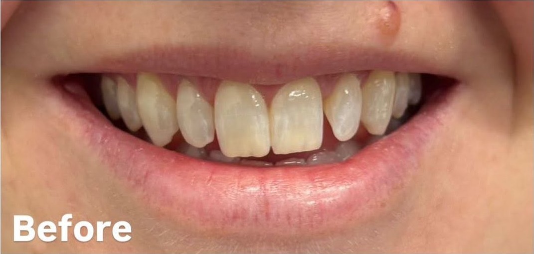 Composite bonding - before
