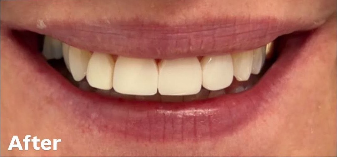Composite bonding - after