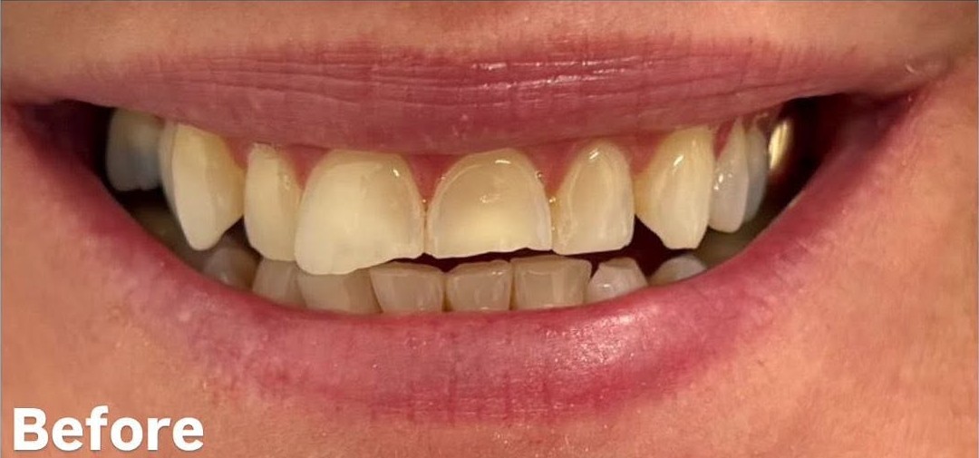 Composite bonding - before