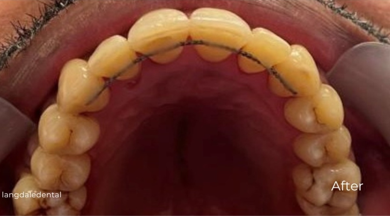 Fixed braces - after