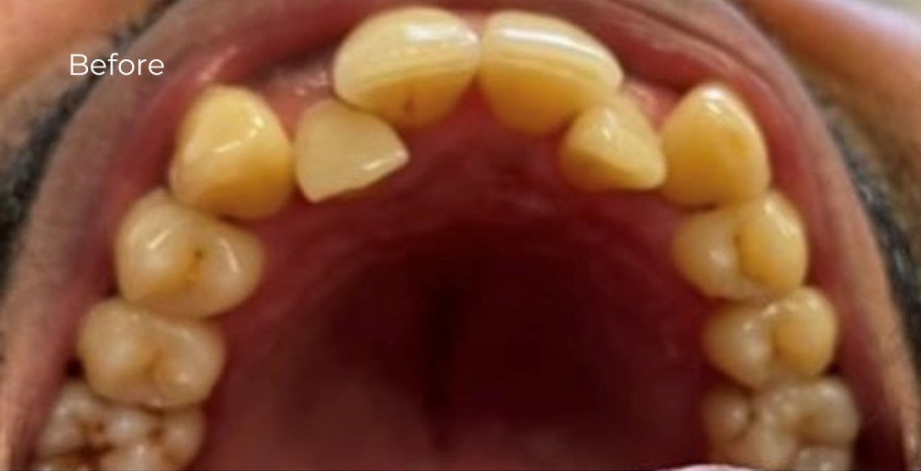 Fixed braces - before