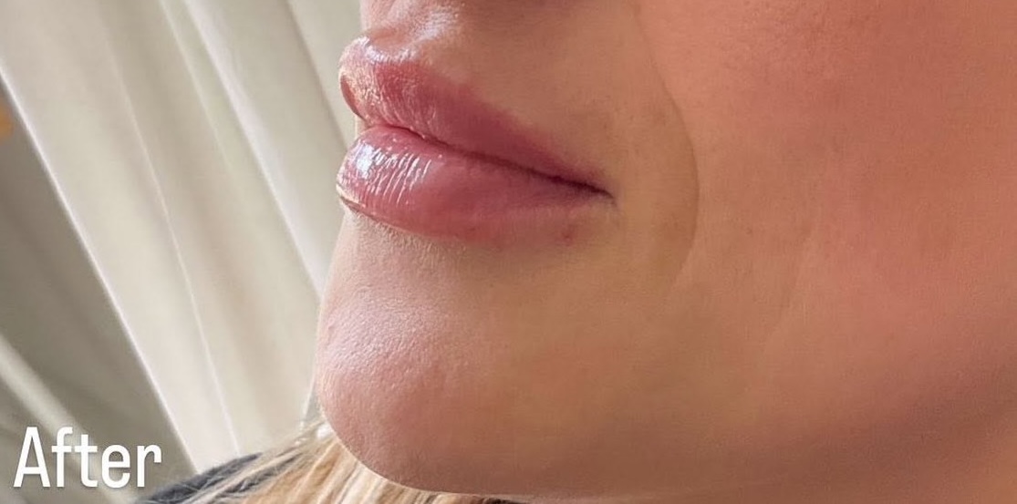 Lip enhancement - after