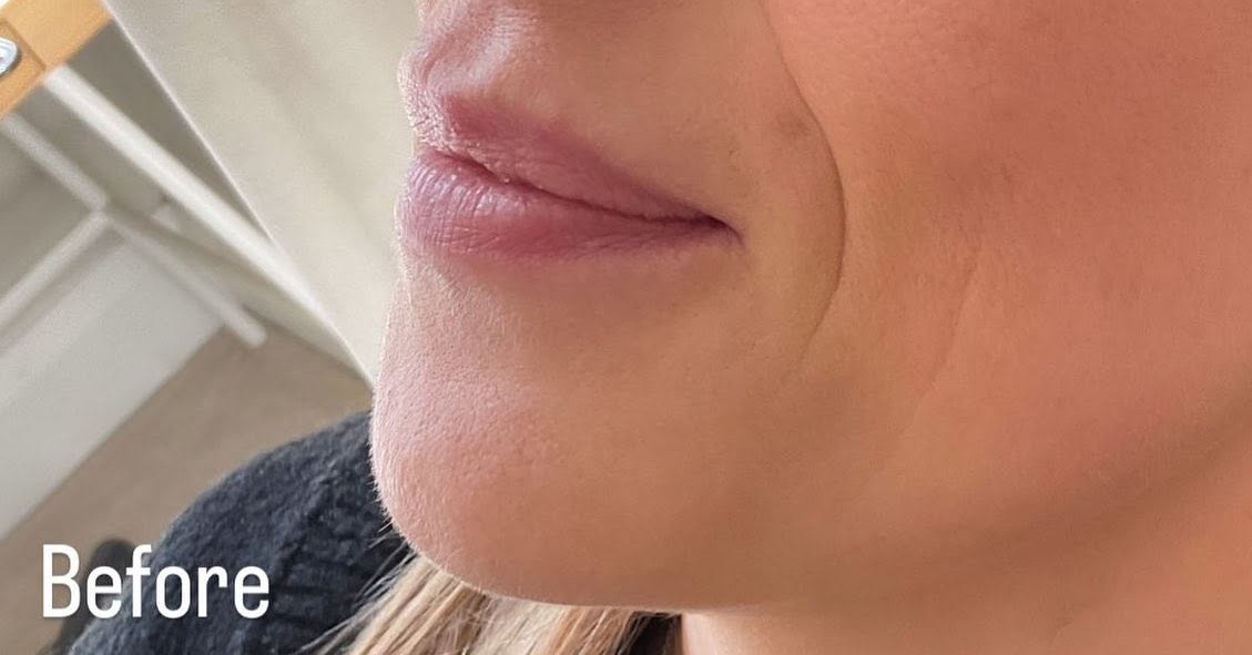 Lip enhancement - before